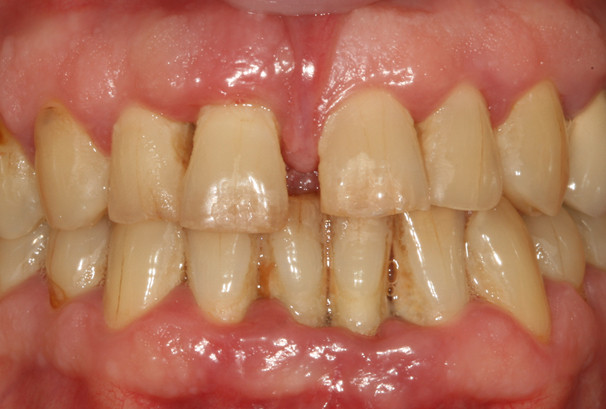 La gencive autour de l'incisive centrale à gauche sur l'image est rouge, inflammatoire. La dent bouge.
