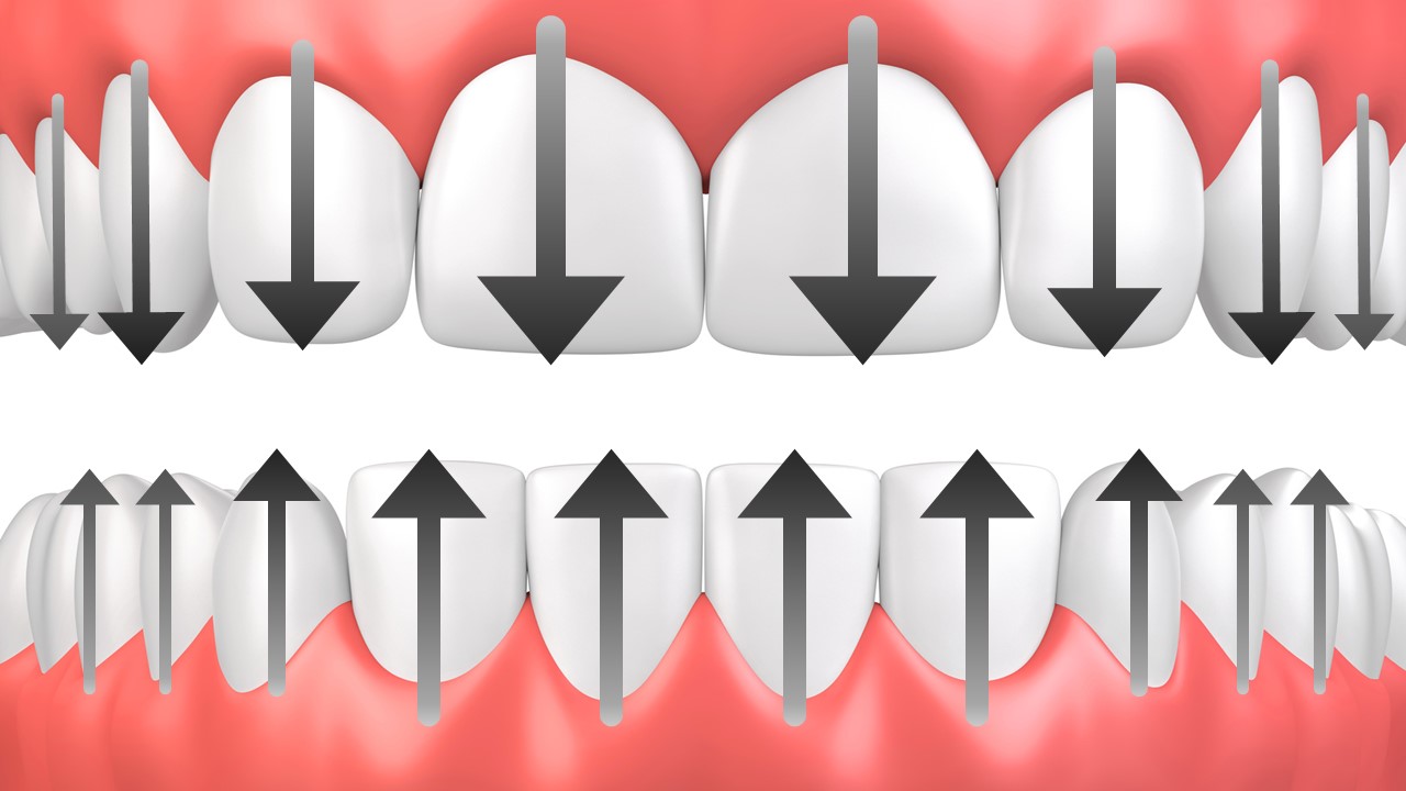 La technique du rouleau simplifiée ParoSphère