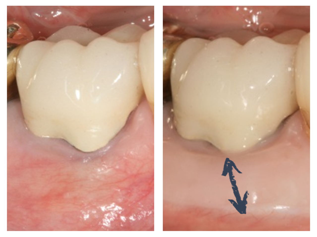 Focus | Traitement des récessions gingivales - ParoSphère