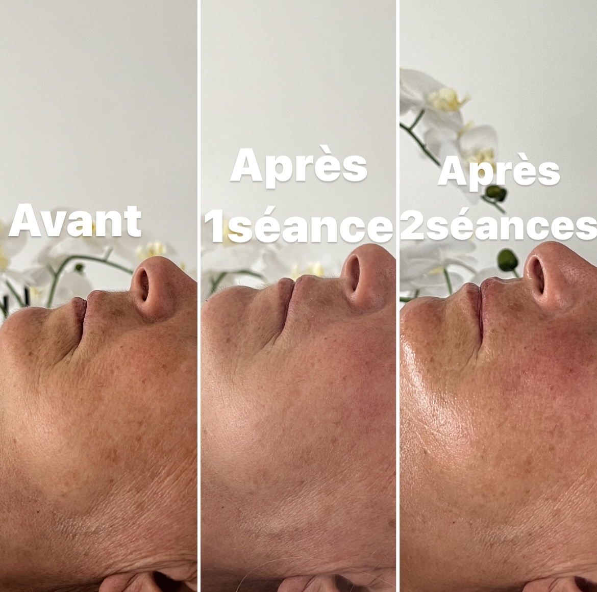 Résultats avant/après de séance d'HIFU visage sur mesure, adaptée au