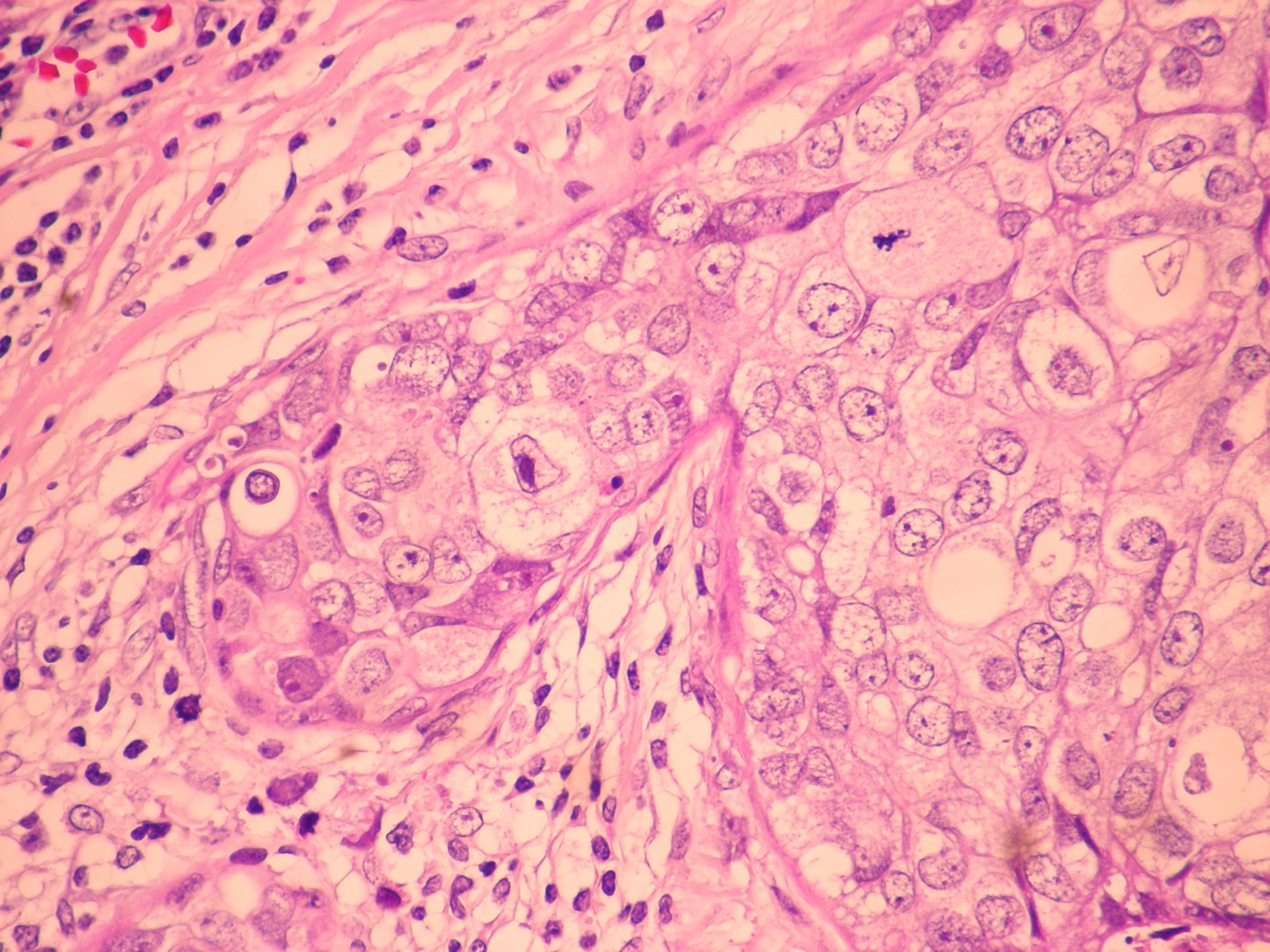 CARCINOMA DUCTAL CON MICROINVASION H&E 40X