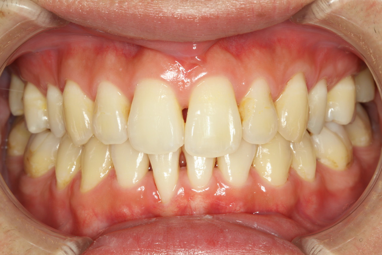 歯 と 歯茎 の 間 に 隙間