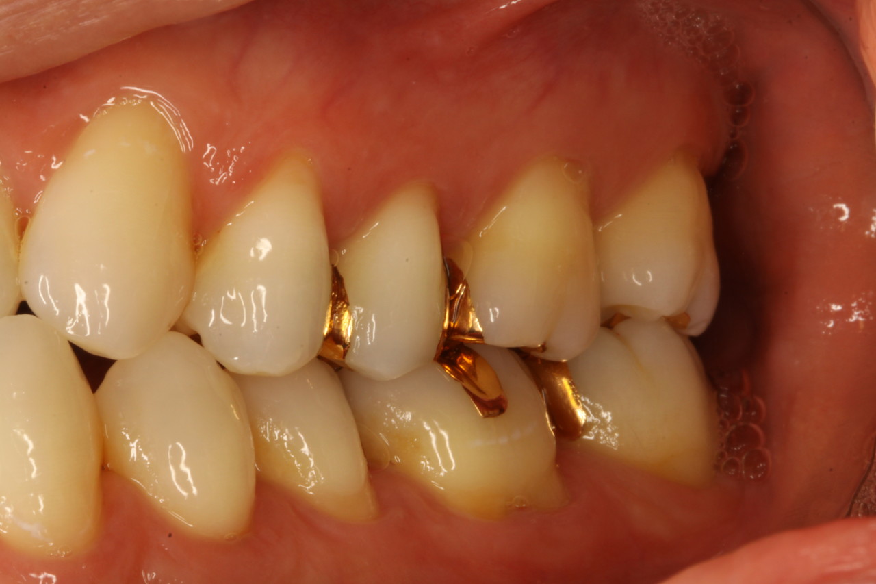 奥歯 の 歯茎