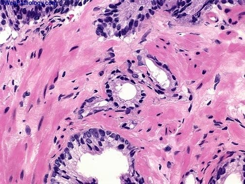 tessuto prostatico con pin alto grado tessuto prostatico con pin alto grado