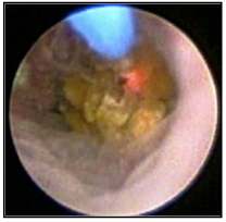 Visione endoscopica di calcolo ureterale durante frammentazione con laser