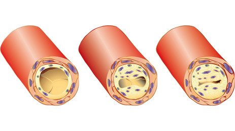 disfunzione erettile e malattie cardiovascolaria
