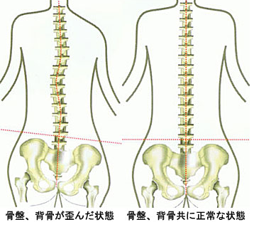 骨盤がゆがむと、骨盤の上にある背骨が傾くので側弯症になります。