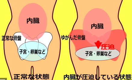 骨盤がゆがむと、骨盤にある内臓に影響がでます。