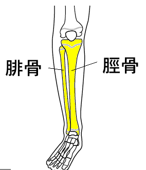 すねの2本の骨が離れると、すねの外側の痛みの原因になります。