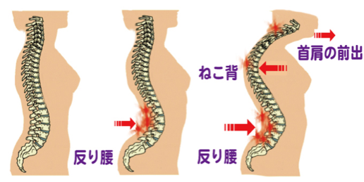 骨盤がゆがむと、その上の背骨が湾曲して猫背やストレートネックの原因となります。
