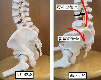 右の写真のように骨盤が後ろに傾くと骨盤がゆがんで腰痛の原因になります。