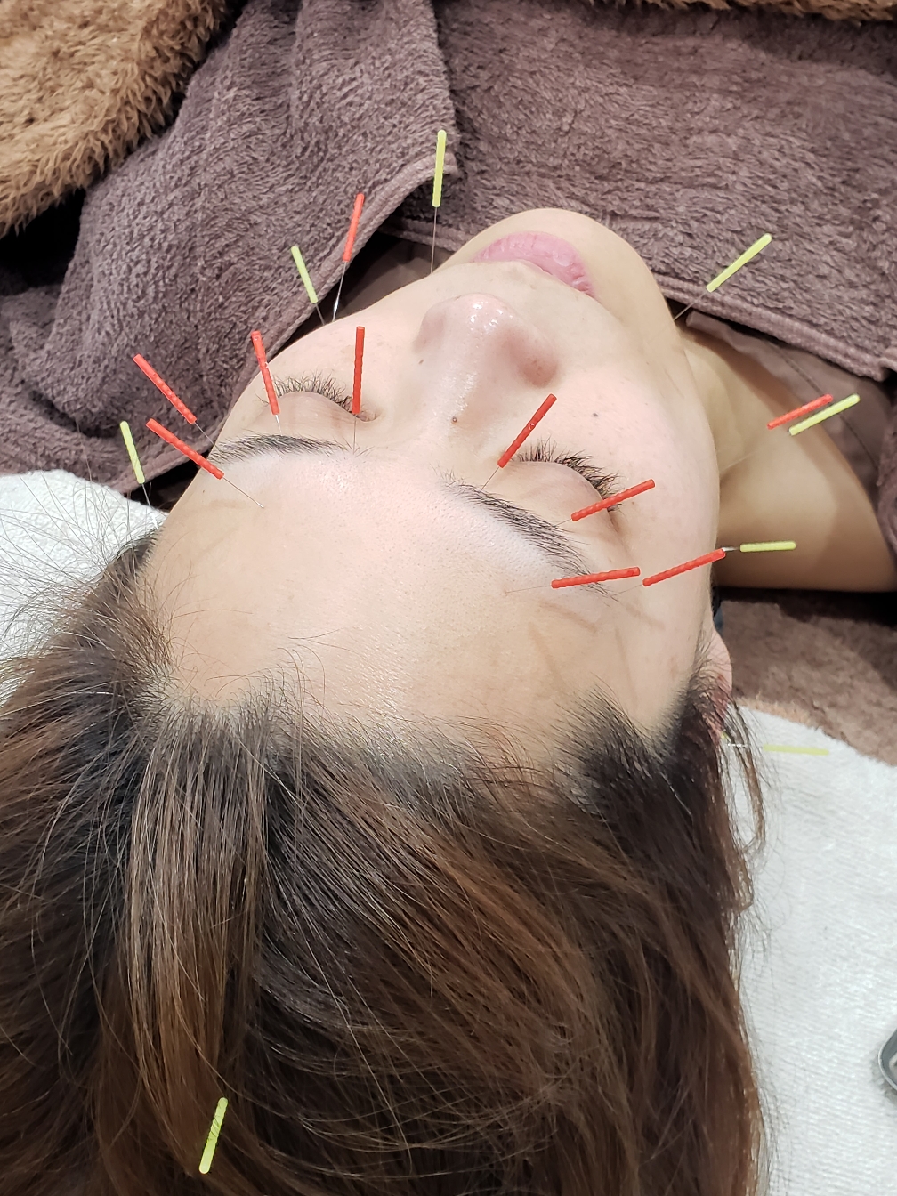 ハリウッド上田式美容鍼灸®