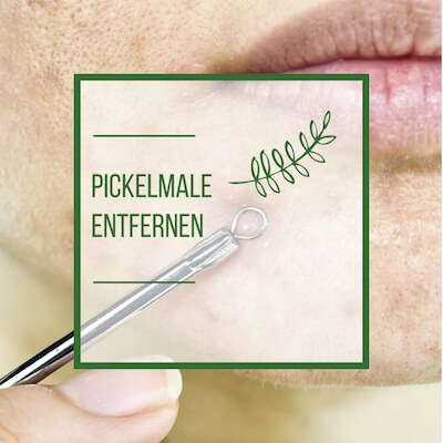 Pickelmale entfernen - Tipps die wirklich helfen