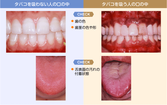 歯周病とたばこ(-。-)y-゜゜゜ - 江南市すぎもと歯科の歯周病・口臭治療
