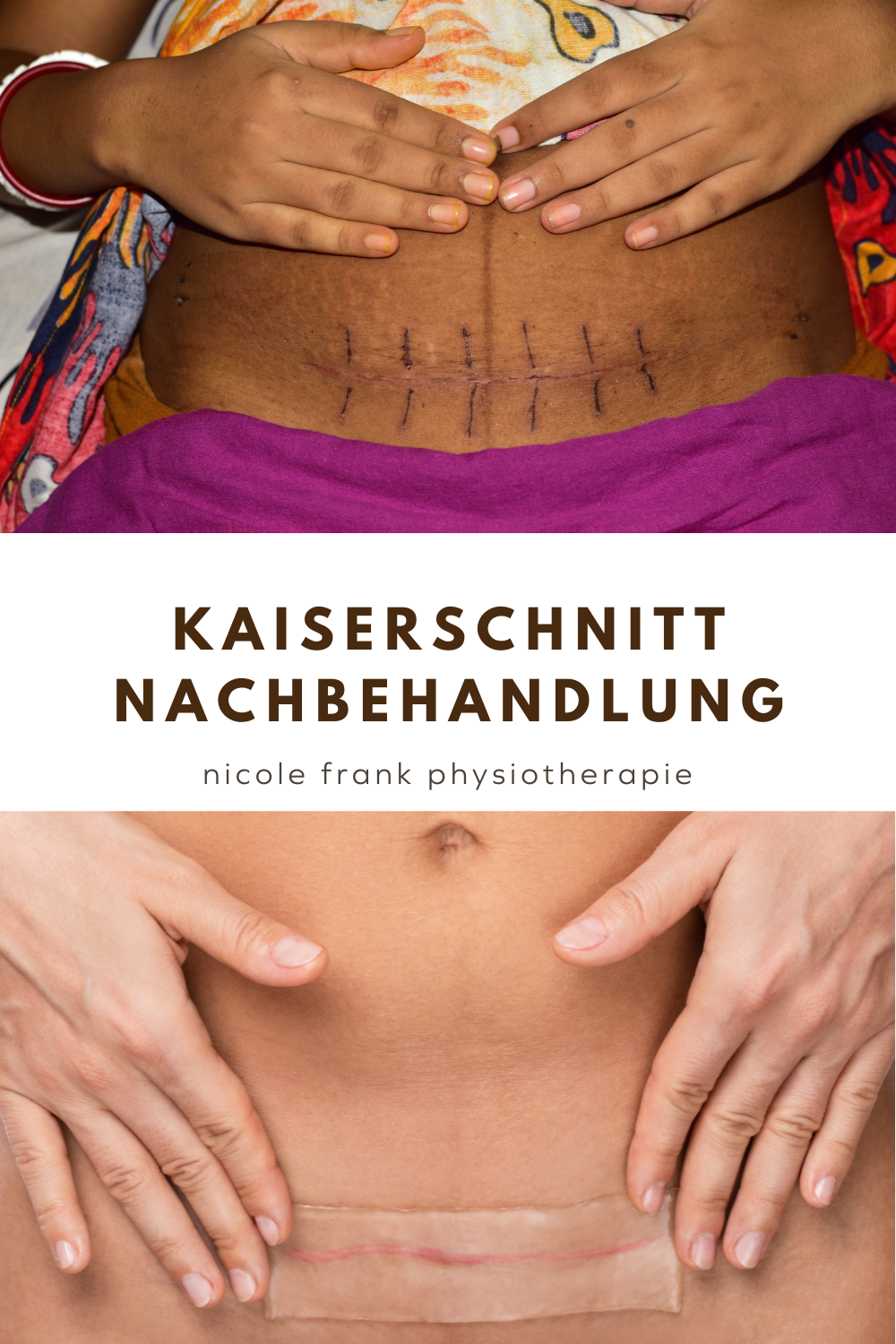 Kaiserschnittnarbe Nicole Frank Physiotherapie