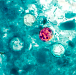 Oocyste de Cyclospora spp. visualisé après coloration de Ziehl-Neelsen modifiée. Certains oocystes ne prennent pas la coloration (https://www.cdc.gov/dpdx/cyclosporiasis/index.html)