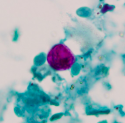 Oocyste de Cyclospora spp. visualisé après coloration de Ziehl-Neelsen modifiée (https://www.cdc.gov/dpdx/cyclosporiasis/index.html)