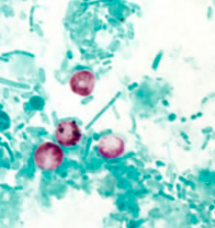 Oocystes de Cryptosporidium spp. colorés par la coloration de Ziehl-Neelsen modifiée (https://www.cdc.gov/dpdx/cryptosporidiosis/index.html)