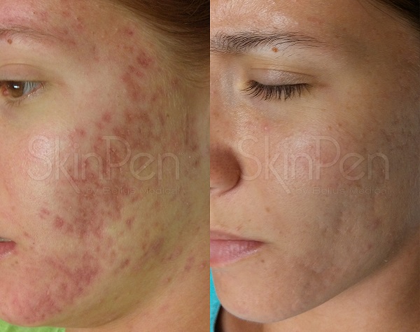 Acne scarring  improvement before and after microneedling treatments