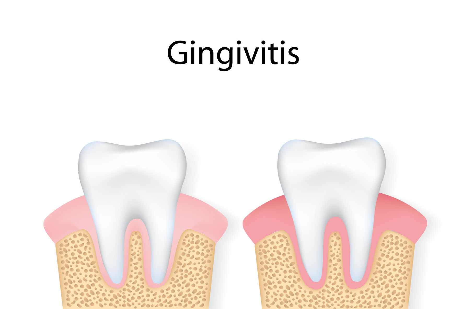 Die Zahnfleischentzündung gezielt behandeln Zahnarzt