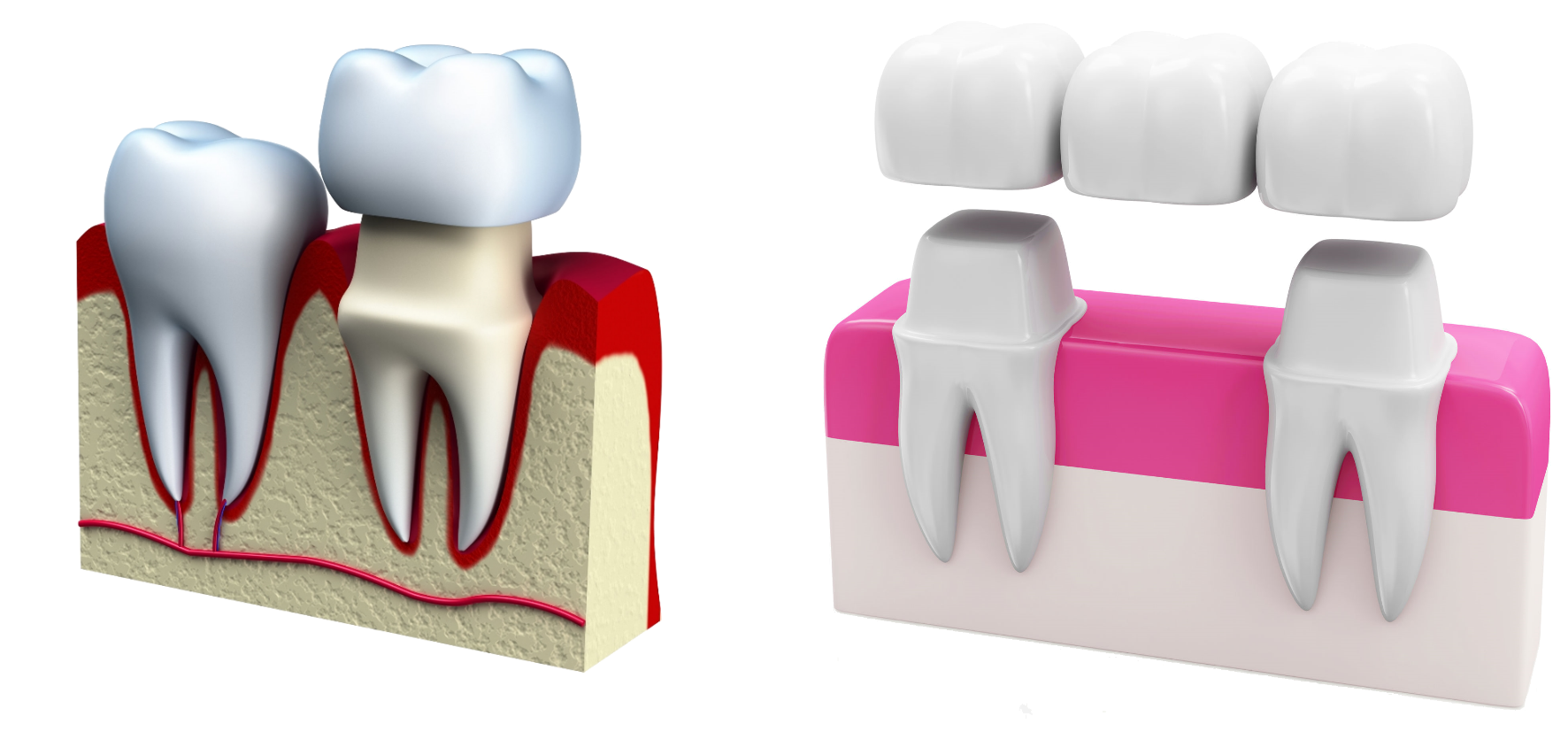 Core crowns