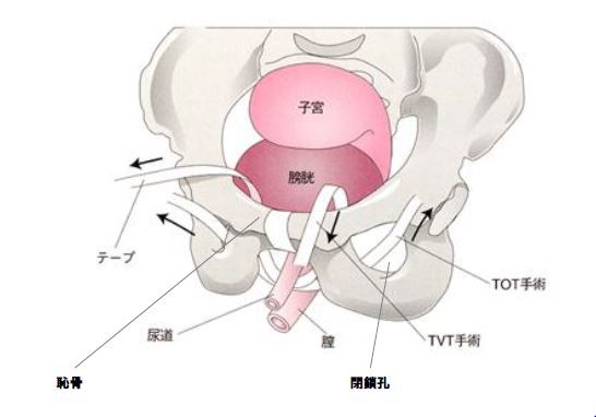 尿失禁　治療　根治　治る　