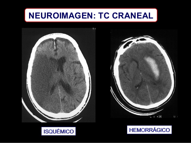 ICTUS ISQUÉMICO VS ICTUS HEMORRÁGICO Y SECUELAS EN LOS ...