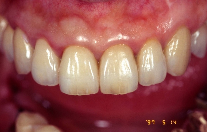  In the mouth of upper jaw full mouse reconstruction. Ovide pontic with maxillary left side incisor. By launching a pontic from the gingival defect in the defect, very esthetic