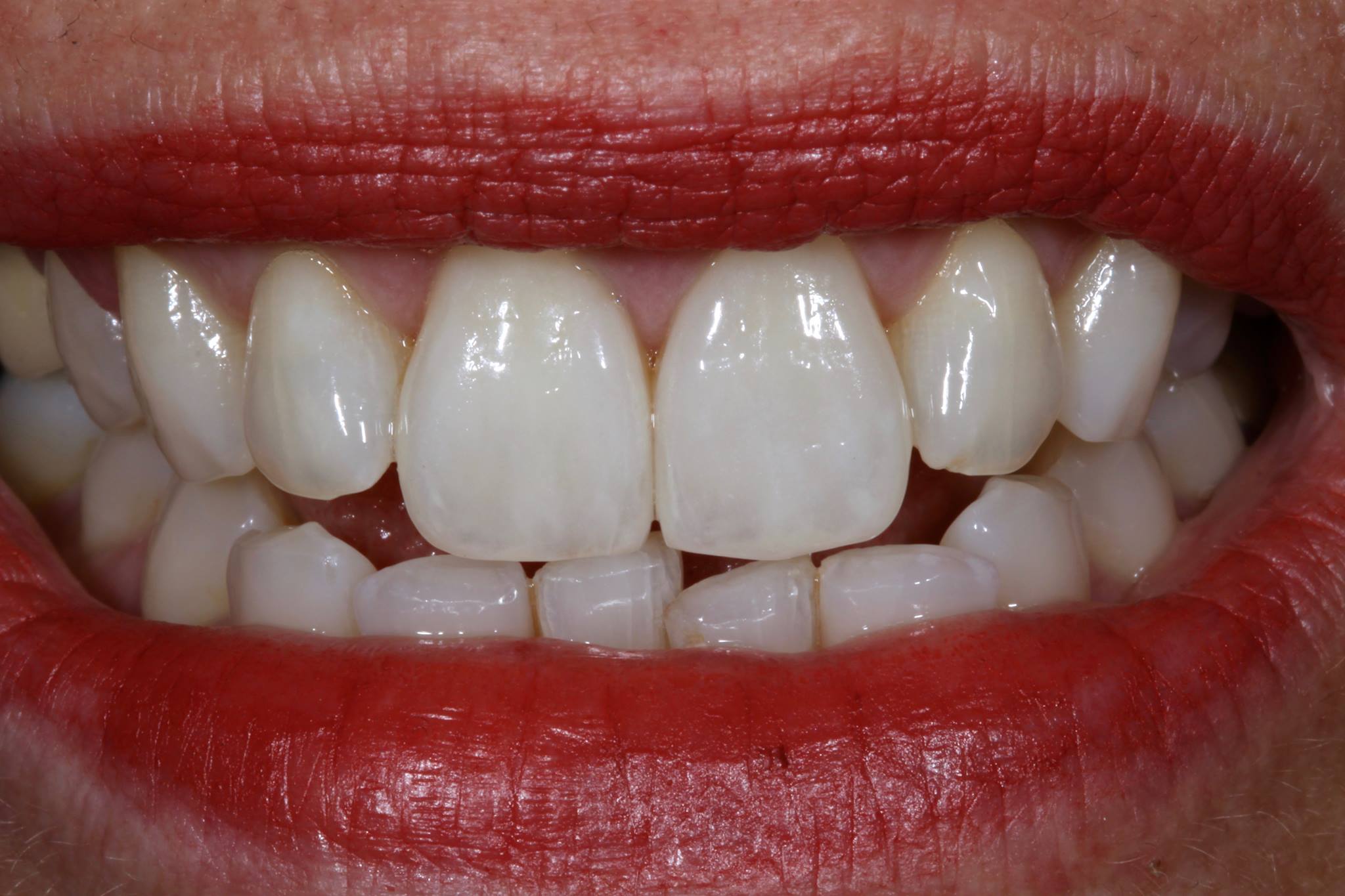 Veneers on #8 and #9