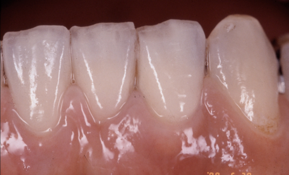AFTER: Metal Ceramic Bridge Worn in Oral Cavity. It also shows that a good prognosis is obtained and it maintains a very aesthetic state.     