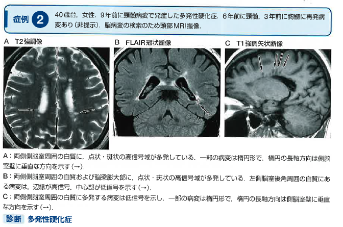 多発性硬化症 multiple sclerosis mri diagnosis ページ