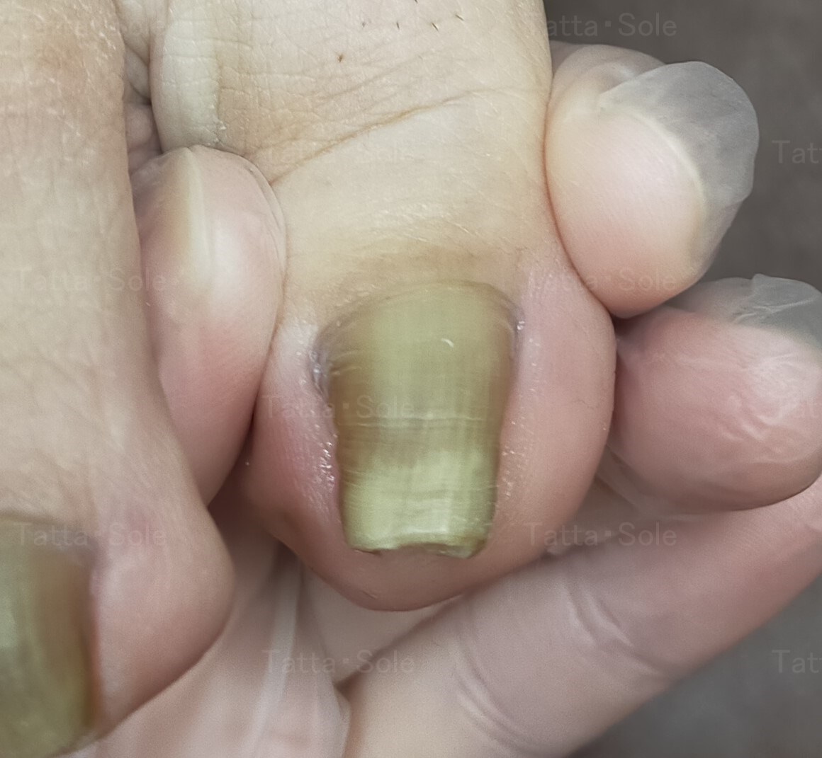 巻き爪補正　2年後　～ドイツ式ワイヤー補正～