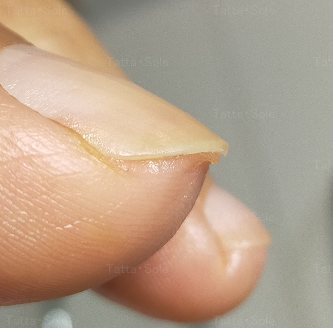 これ以上短くは切れません～爪の下の皮が長いタイプ～