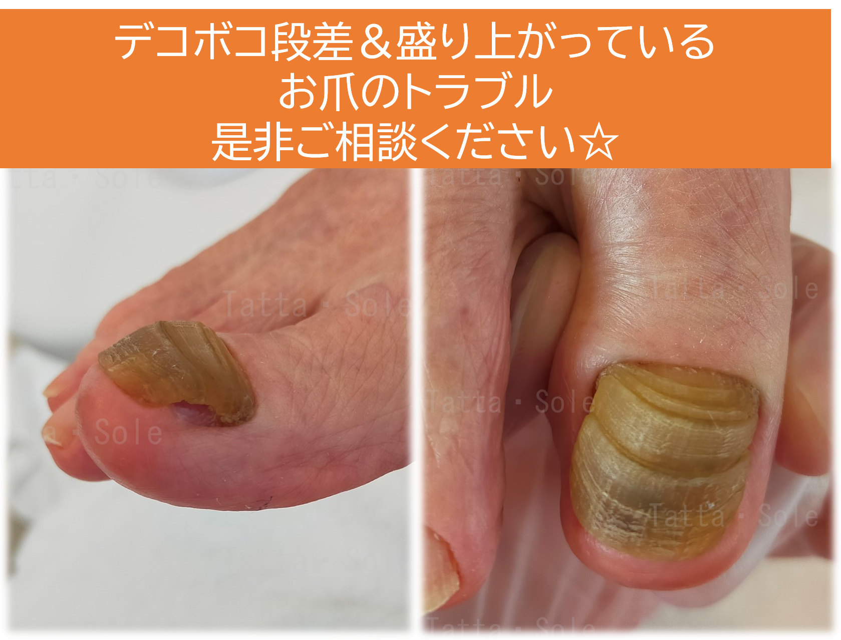 爪甲鉤彎症 そうこうこうわんしょう ケア タッタ ソール