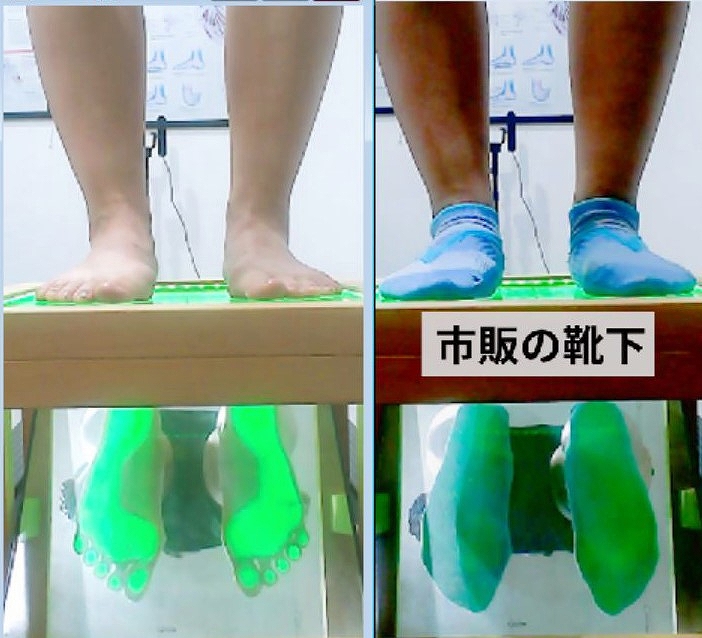 症例104│立位静止時におけるスポーツソックス着用による足アーチ構造の変化