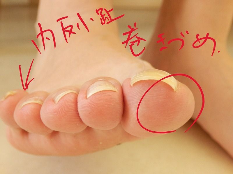 巻爪（まきづめ）