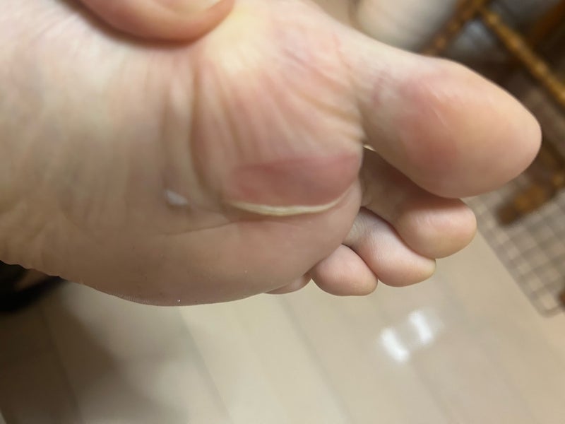 マメと靴擦れの違いを知ろう│足の裏トラブルとランニングの関係
