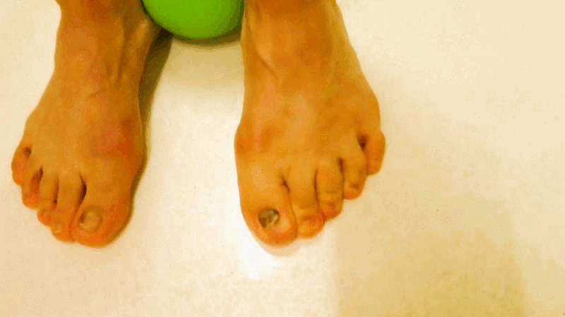 外反母趾の治し方