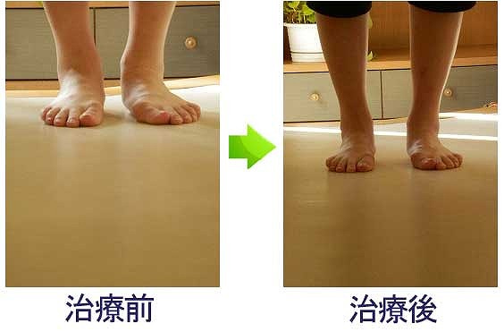 偏平足 足の痛みの特化ラボ 偏平足 足の痛みの特化ラボ