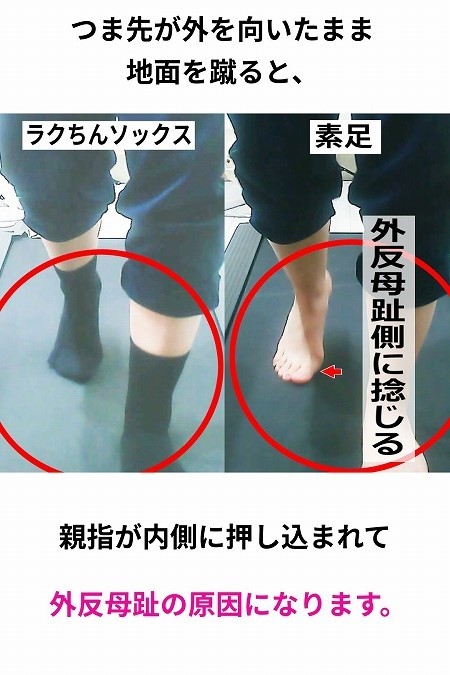外反母趾が気になるあなたへ│オススメの靴下