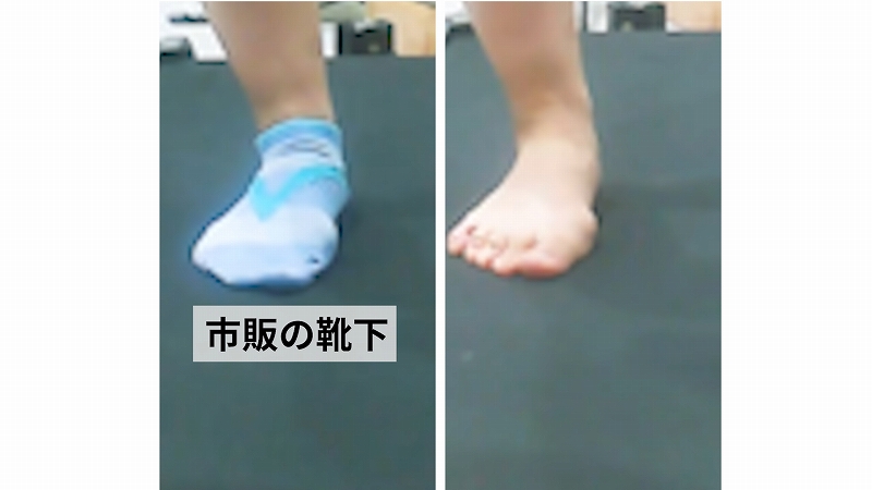 症例102│スポーツソックス着用によるアーチの低下の比較（動画あり）