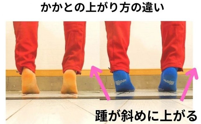 足底筋膜炎の原因