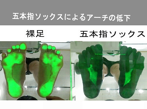 足底筋膜炎のリハビリテーション