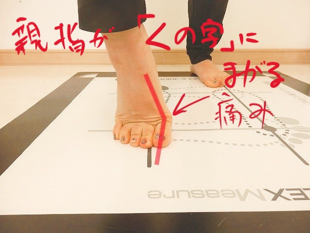 alt="親指の付け根に負担が集中し痛みが出やすい足部の状態"