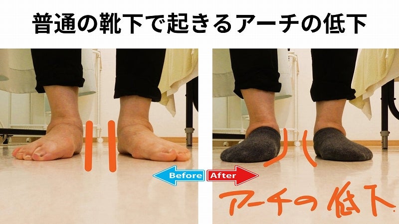普通の靴下で、なぜ足のアーチは低下したのか