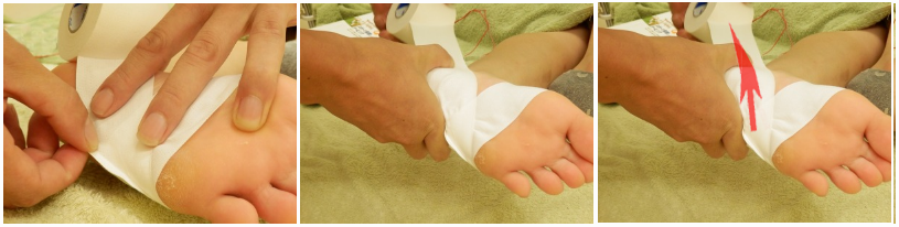 足底腱膜炎（足底筋膜炎）のテーピング貼り方