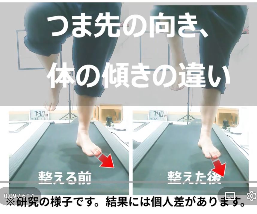 足底腱膜炎の原因になるつま先の向きの説明