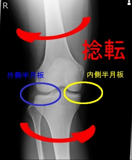 ランナーの半月板損傷を自分で治すために行う説明の画像