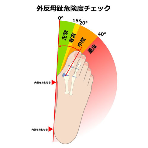 外反母趾がテーピングなかなか改善しない理由