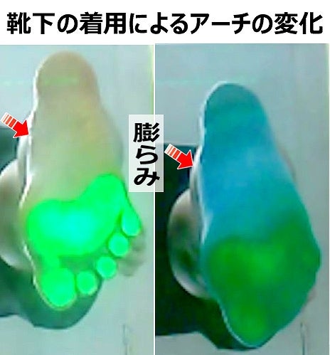 症例107│ソックス着用による内側アーチの膨隆を観察した